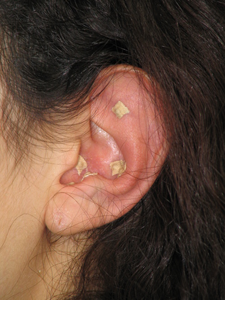 Ear-acupuncture.png
